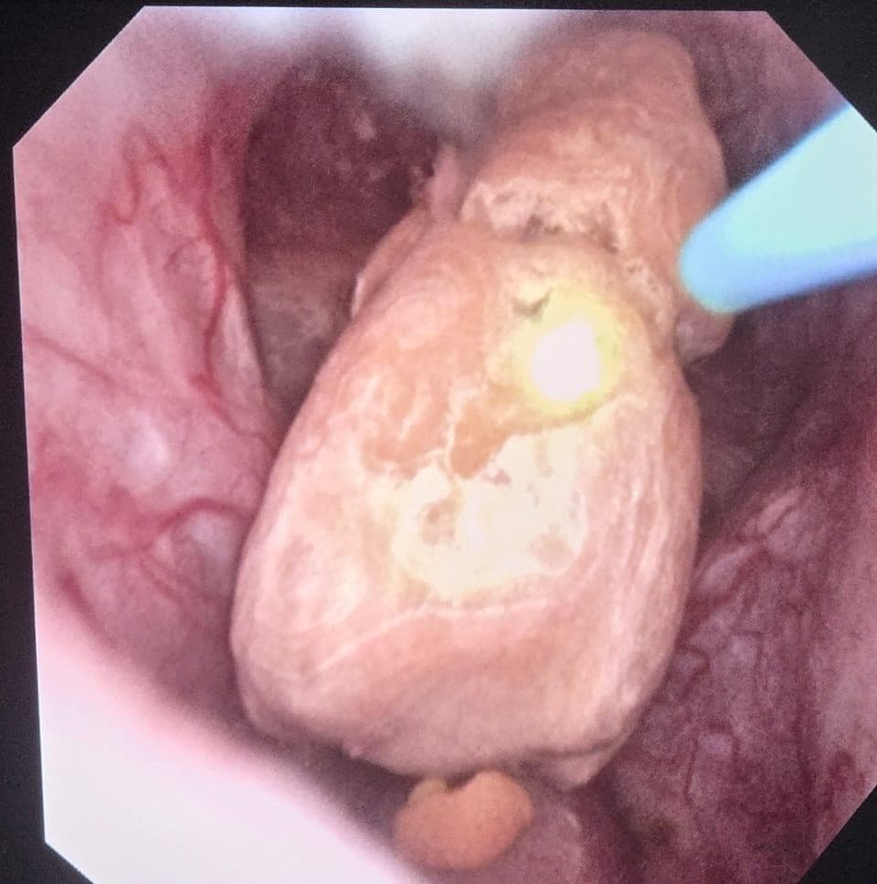 Vue endoscopique per-opératoire