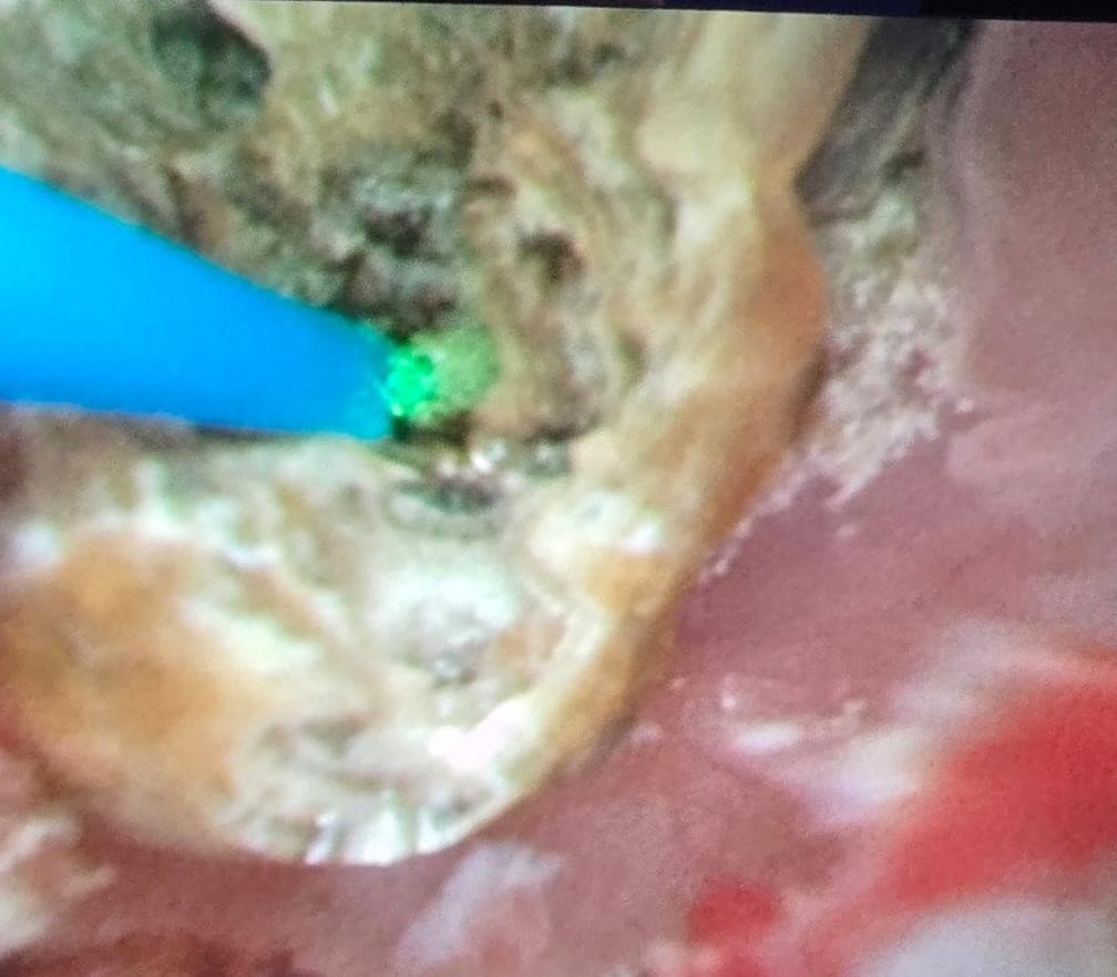 Geste endoscopique en cours